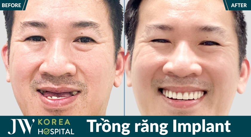 Hình ảnh trước và sau của khách hàng khi trồng răng Implant