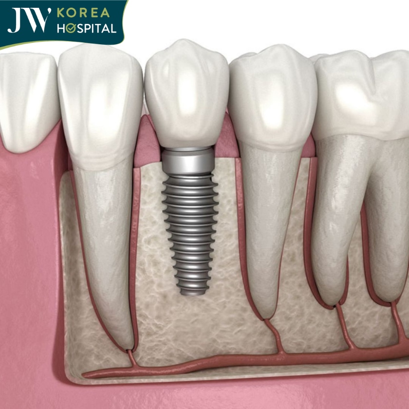 Trồng răng Implant là phương pháp cấy một trụ titanium vào xương hàm, đóng vai trò như chân răng thật.