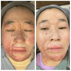 trước và sau khi điều trị sẹo bỏng tại jw
