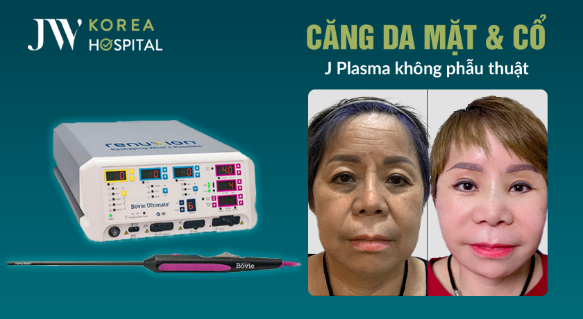 Công nghệ căng da mặt và cổ J Plasma