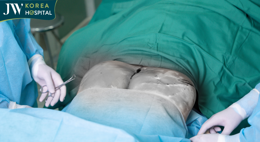 Vòng 3 của bệnh nhân bị áp xe, nhiễm trùng nghiêm trọng sau 4 năm nâng vòng 3