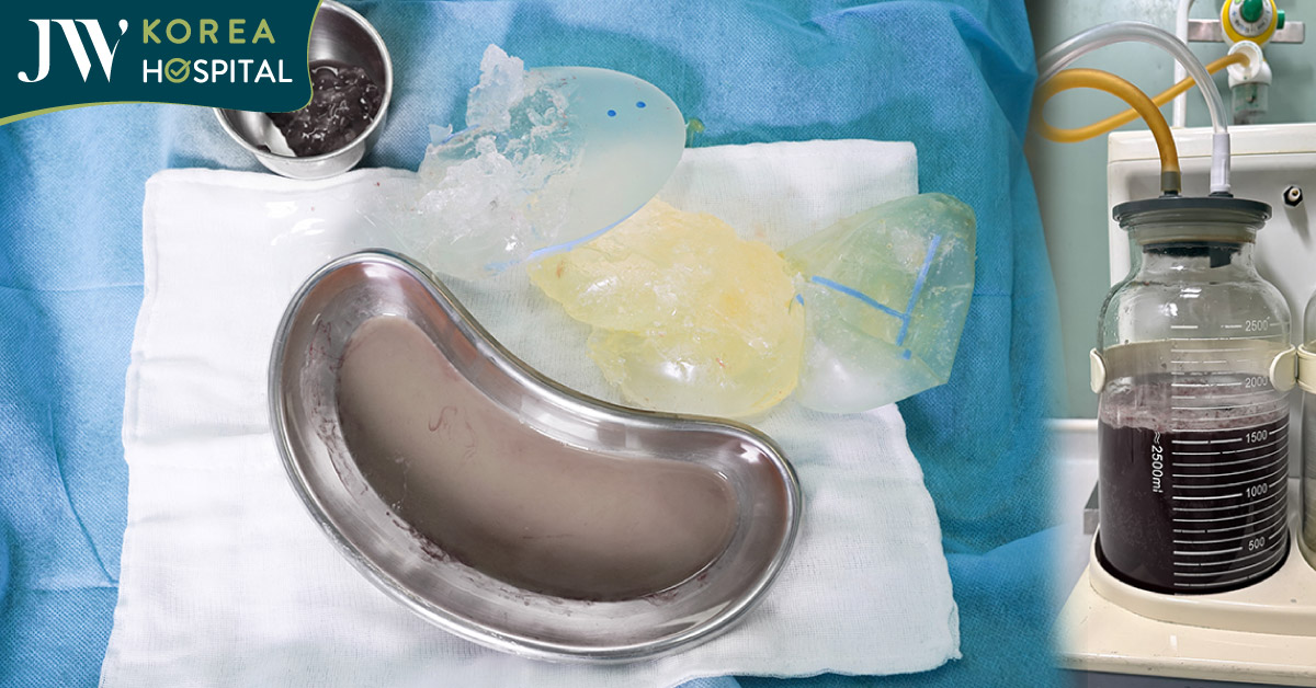 Bệnh viện JW cấp cứu khẩn ca vỡ túi độn mông, silicone tuôn trào như thác