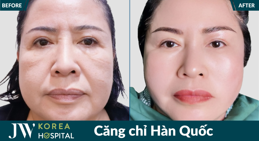 Căng chỉ Hàn Quốc tại Bệnh viện JW giúp xóa chảy xệ trẻ lại 20 tuổi