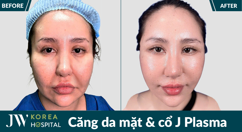 Căng da mặt và cổ J Plasma