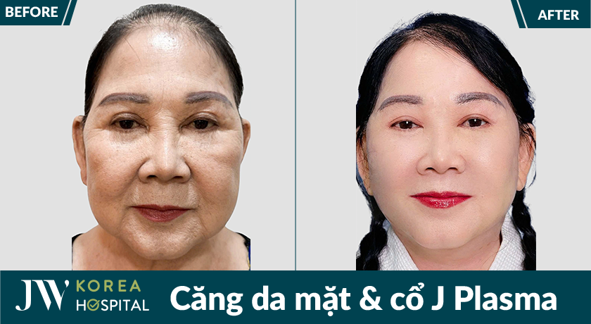 Căng da mặt và cổ J Plasma
