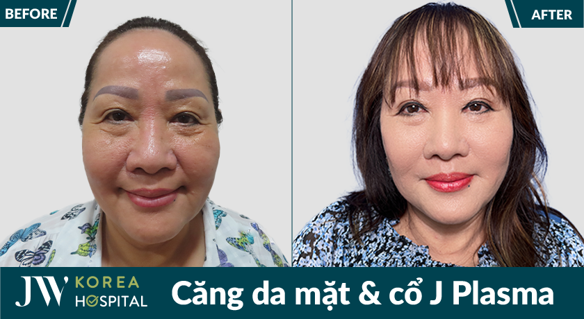 Căng da mặt và cổ J Plasma