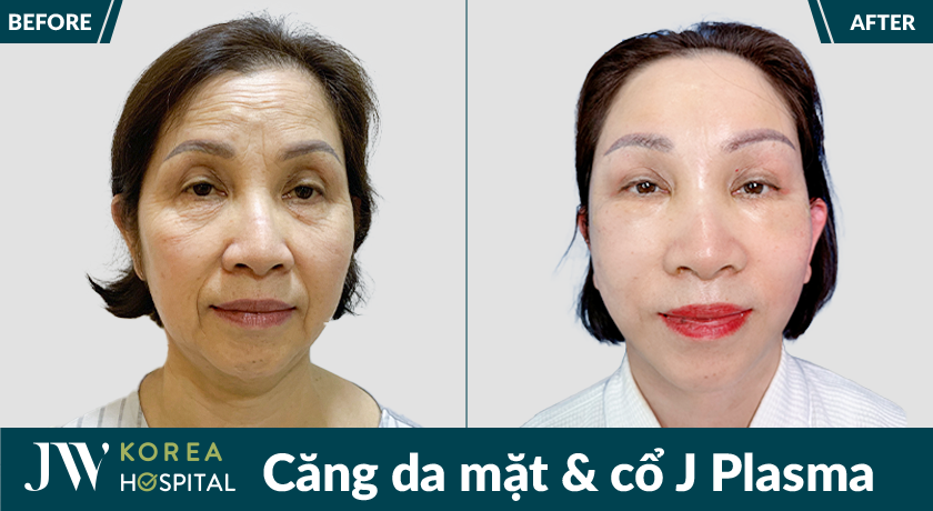 Căng da mặt và cổ J Plasma