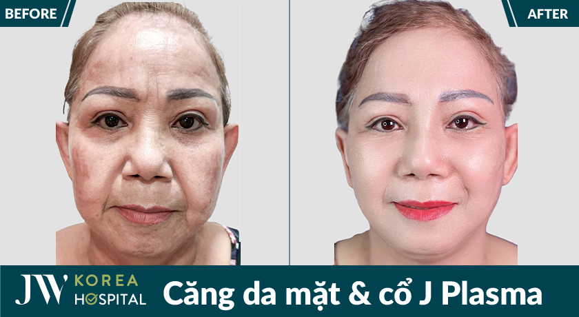Căng da mặt và cổ J Plasma
