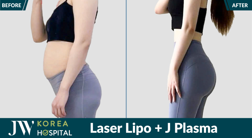 Đánh bay mỡ thừa hiệu quả với siêu công nghệ Laser Lipo và J Plasma tại JW