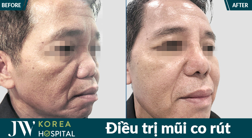 ác ca biến chứng nặng đều được xử lý bài bản và an toàn tại Bệnh viện JW