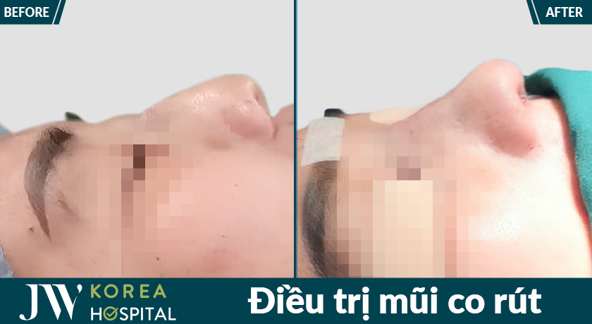 Bệnh viện JW là địa chỉ uy tín trong điều trị biến chứng sau phẫu thuật thẩm mỹ 