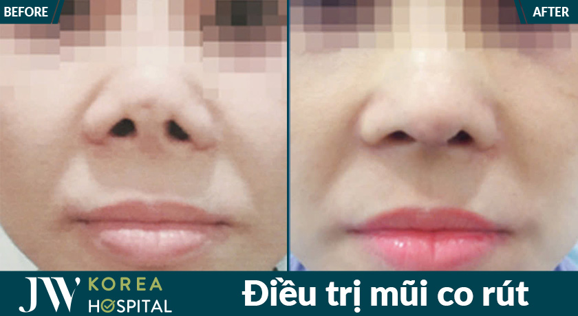 Hàng trăm trường hợp thẩm mỹ lỗi đã được khắc phục an toàn tại Bệnh viện JW