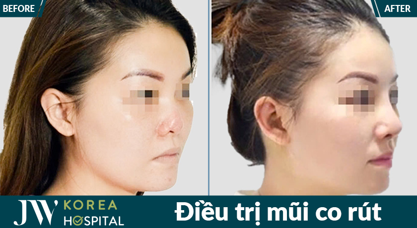 Bác sĩ Tú Dung đã xử lý thành công nhiều ca nâng mũi hỏng, giúp khách hàng lấy lại dáng mũi tự nhiên