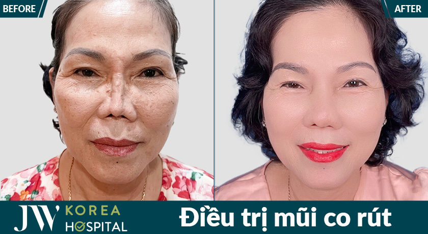 Bệnh viện JW tiếp nhận và điều trị thành công nhiều ca thẩm mỹ hỏng