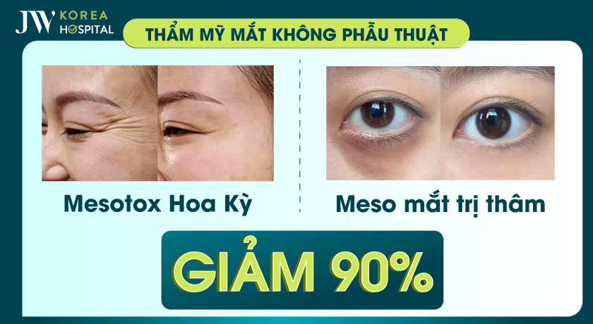 Miễn phí 90% mesotox chuẩn Hoa Kỳ và Meso trị thâm mắt tại JW