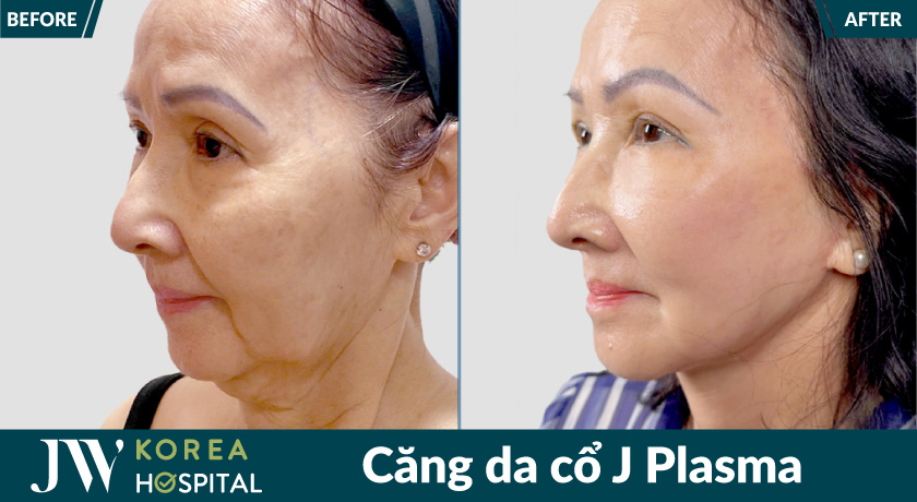 Hình ảnh khách hàng trẻ ngoạn mục sau khi căng da cổ bằng công nghệ J Plasma tại bệnh viện JW