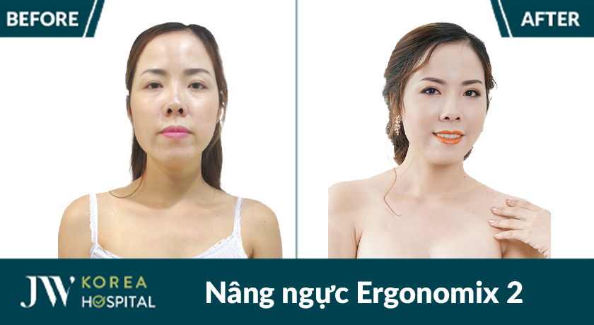 Hình ảnh khách hàng trước và sau nâng ngực túi Ergonomix 2 tại Bệnh viện JW