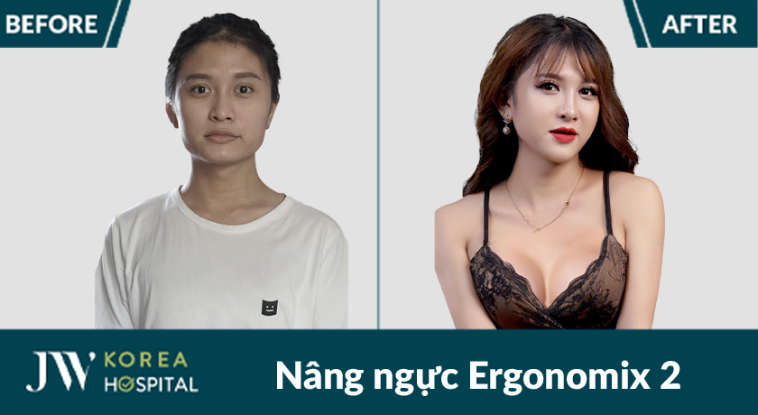 100% khách hàng hài lòng sau nâng ngực túi Ergonomix 2 tại Bệnh viện JW