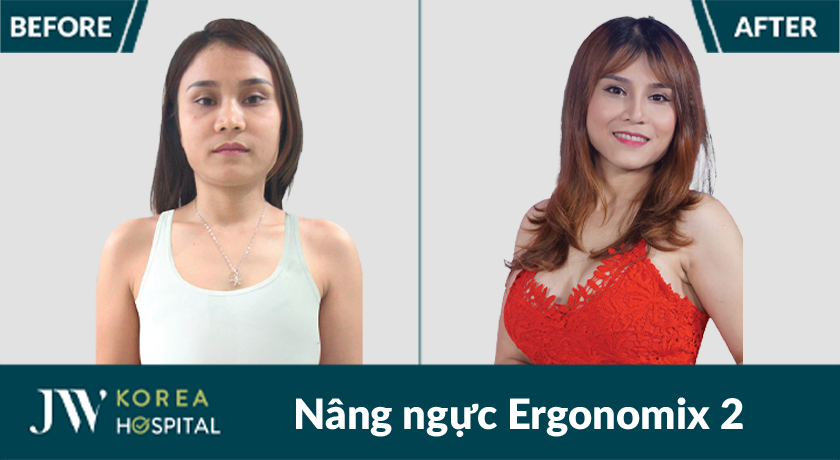 Vòng 1 căng tròn, quyến rũ, an toàn gần như tuyệt đối với túi Ergonimix 2 tại Bệnh viện JW