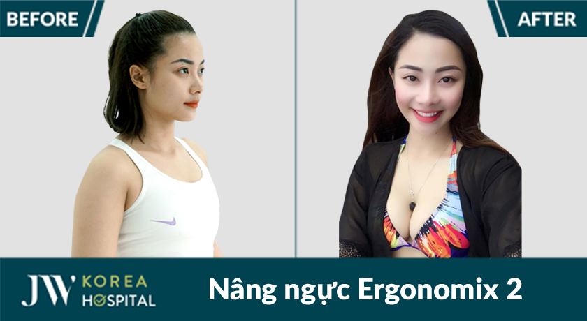 Kết quả của khách hàng sau khi nâng ngực túi Ergonomix 2 tại Bệnh viện JW