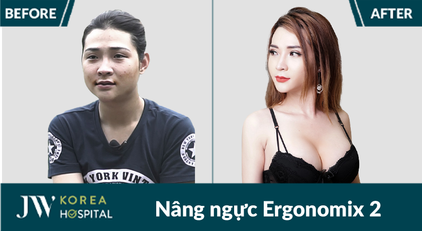Nâng ngực bằng túi Ergonomix 2 tại Bệnh viện JW giúp sở hữu vòng 1 quyến rũ, căng tròn