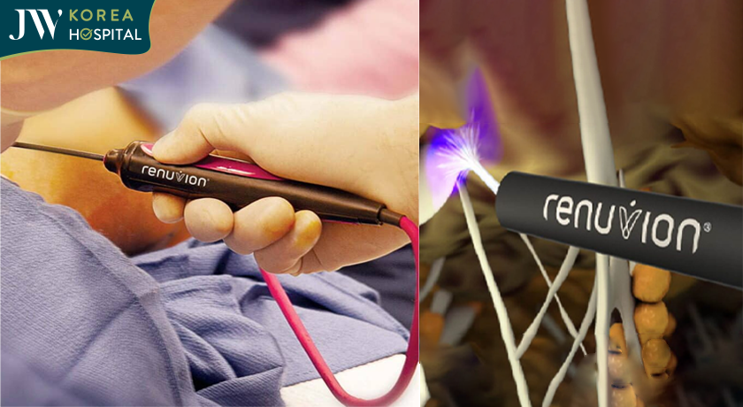 Lợi ích của kĩ thuật J Plasma