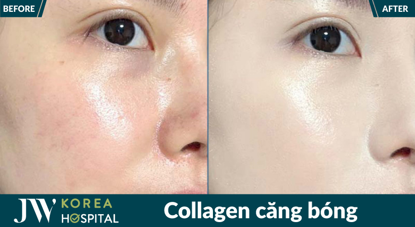Làn da căng bóng, mịn màng sau liệu trình Meso Collagen chuẩn Hàn tại bệnh viện JW