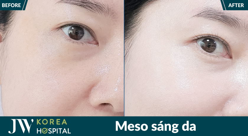 Làn da trắng sáng, căng mịn với Meso sáng da tại bệnh viện JW