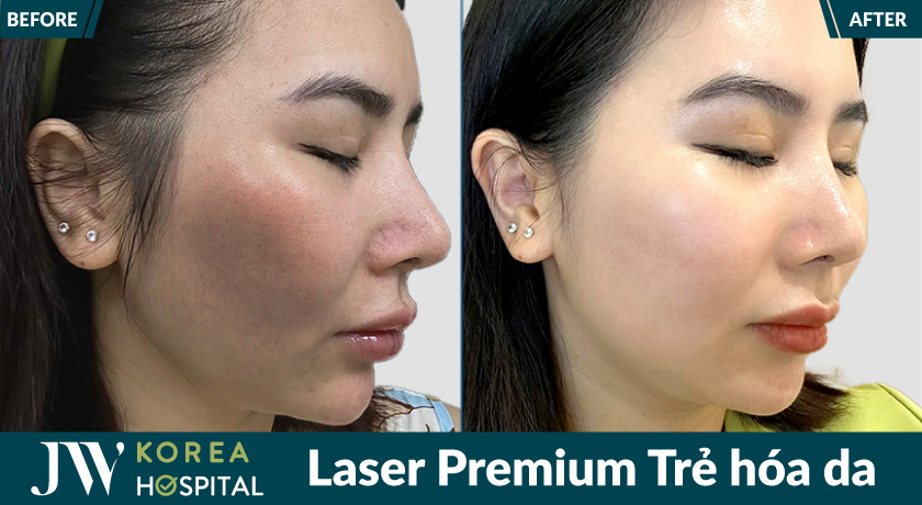 Laser Premium tại Bệnh viện JW giúp trẻ hóa da, tái sinh làn da mịn màng, trắng sáng