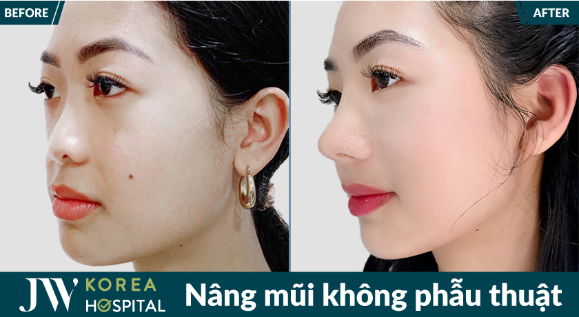 Nâng mũi không phẫu thuật tại bệnh viện JW giúp sở hữu dáng mũi cao tự nhiên bằng mỡ tự thân