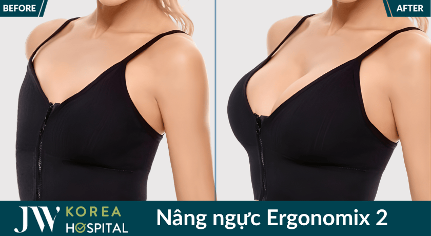 Nâng ngực Ergonomix 2 giúp sở hữu vòng 1 căng tròn quyến rũ cho chị em phụ nữ