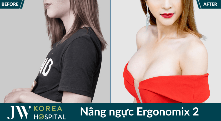 Vòng 1 đẫy đà, quyến rũ sau nâng ngực Ergonomix 2 tại Bệnh viện JW