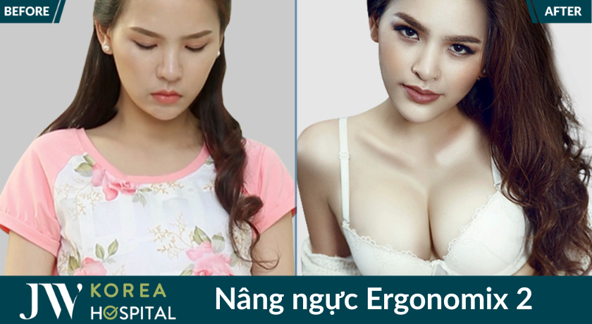 Nâng ngực Ergonomix 2 tại Bệnh viện JW được nhiều khách hàng tin chọn