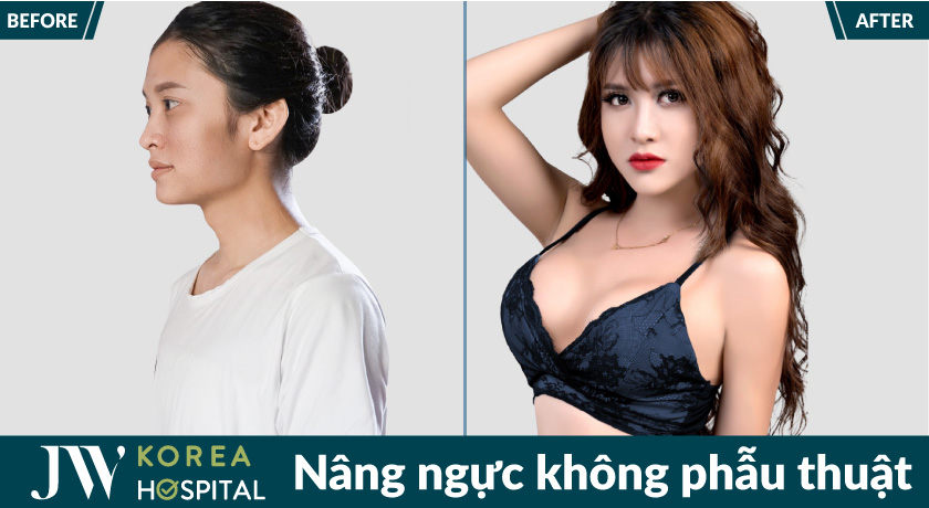 Nâng ngực không phẫu thuật tại bệnh viện JW giúp sở hữu dáng ngực mềm mại, quyến rũ