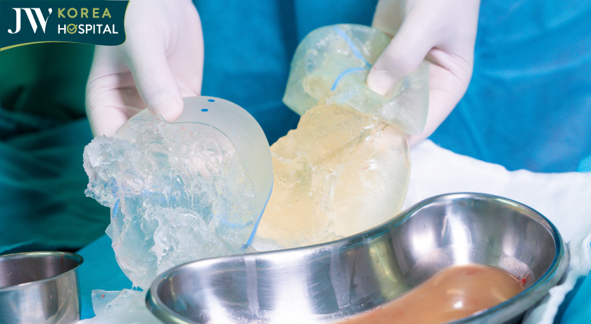 2 túi độn mông của bệnh nhân vỡ nát, silicon chảy khắp khoang mổ