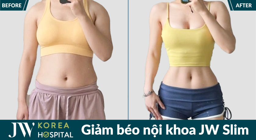 Vòng eo thon gọn chỉ sau 1 liệu trình giảm béo nội khoa không phẫu thuật tại bệnh viện JW