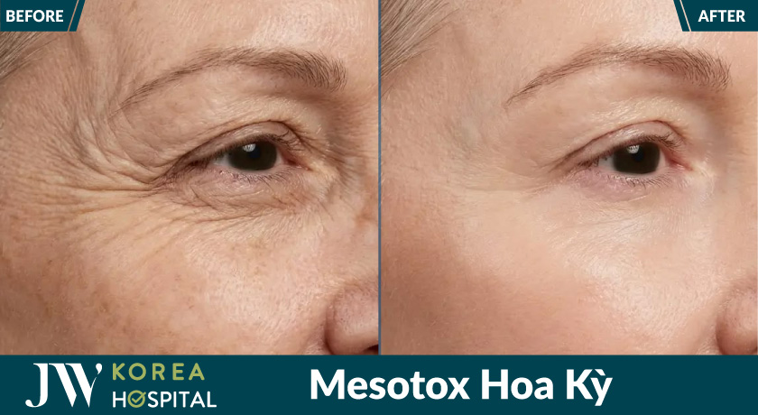Xóa nếp nhăn đuôi mắt, trẻ 10 tuổi sau liệu trình tiêm mesotox tại bệnh viện JW