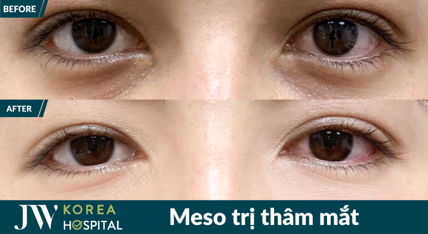 Xóa quầng thâm mắt hiệu quả với liệu trình meso tại bệnh viện JW