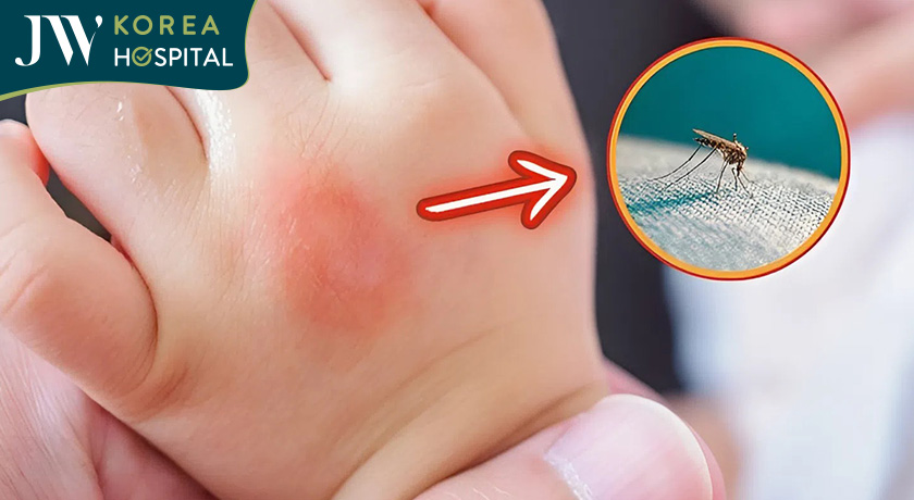 Trẻ em bị muỗi cắn dễ mắc bệnh sốt rét 