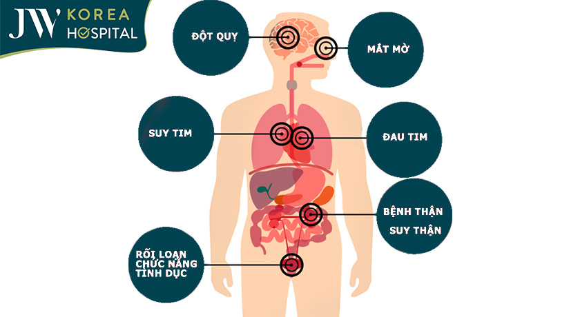 Biến chứng nguy hiểm thường gặp ở bệnh nhân tăng huyết áp