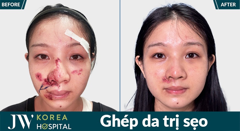 Cô gái trẻ bị tai nạn được ghép da trị sẹo tại JW