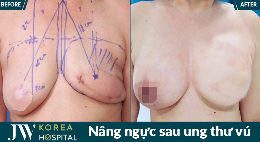 Hình ảnh trước và sau điều trị của bệnh nhân ung thư vú tại JW 