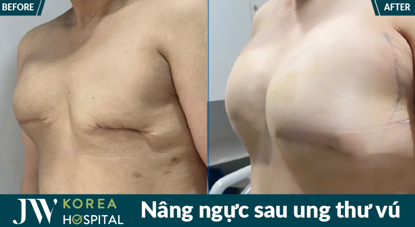 Bệnh nhân ung thứ vú được tái tạo ngực mới tại bệnh viện JW