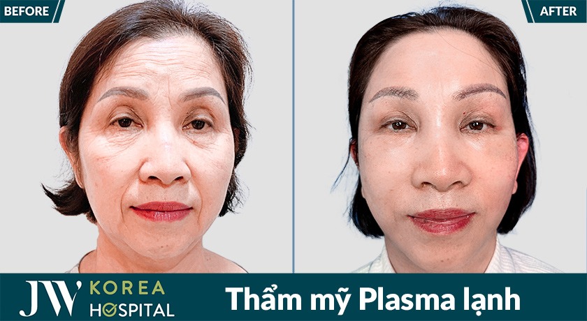 Hình ảnh khách hàng sau khi trải nghiệm công nghệ Plasma lạnh Plasmarosy tại JW