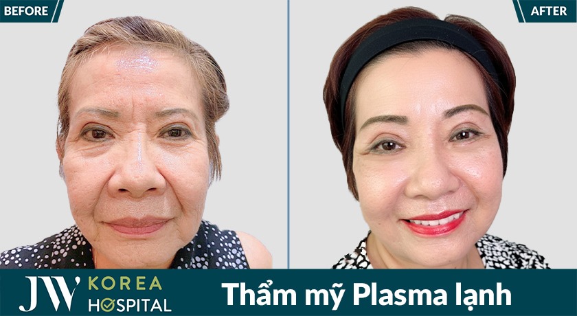 Khách hàng không còn cảm giác sưng đỏ, đau rát sau phẫu thuật nhờ công nghệ Plasma lạnh Plasmarosy tại bệnh viện JW