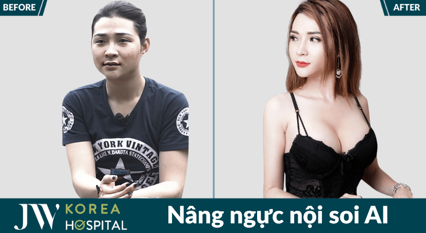 Kết quả trước và sau nâng ngực nội soi AI tại bệnh viện JW