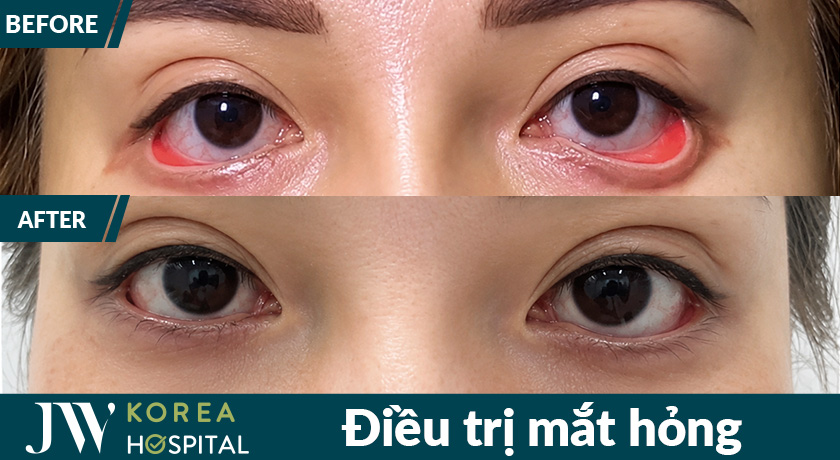 Kết quả trước và sau khi điều trị mắt của 1 bệnh nhân bị biến chứng sau phẫu thuật lỗi