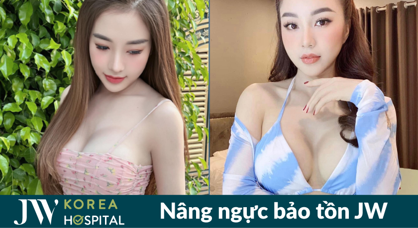 Hình ảnh trước và sau nâng ngực bảo tồn tại bệnh viện JW 