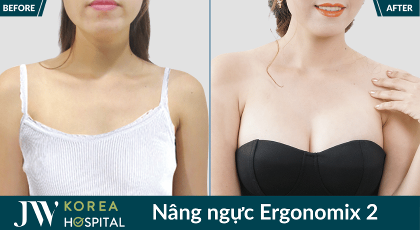 Hình ảnh trước và sau của khách hàng khi nâng ngực bằng túi ngực Ergonomix 2 tại bệnh viện JW 