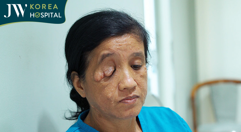 Chị Bé Phương sống với khối u sợi thần kinh hơn 50 năm 